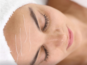 Collagen protein thread facial treatment at London Body Clinic for smoother, firmer and more youthful-looking skin