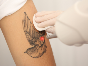 Laser tattoo removal treatment at London Body Clinic using advanced laser technology to target unwanted tattoo pigment