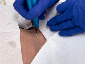 Cryotherapy freeze therapy treatment at London Body Clinic for targeted removal of suitable skin lesions and imperfections