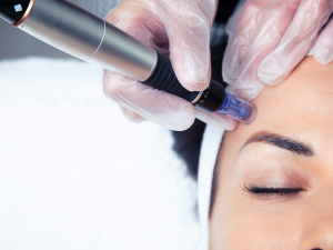 Microneedling facial treatment at London Body Clinic for skin rejuvenation, acne scars, fine lines and improved skin texture