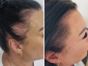 Scalp micropigmentation treatment at London Body Clinic for thinning hair, receding hairlines and the appearance of fuller hair