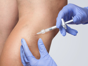 Sclerotherapy Vein Treatment: A Targeted Treatment for Spider and Small Leg Veins