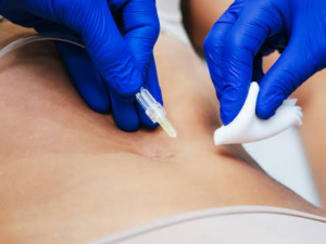 Carboxytherapy treatment at London Body Clinic for skin rejuvenation, cellulite, stretch marks and body concerns