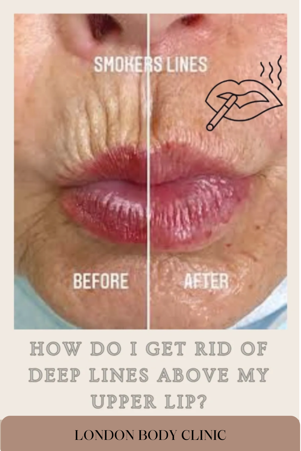 Woman with visible deep lines above the upper lip.